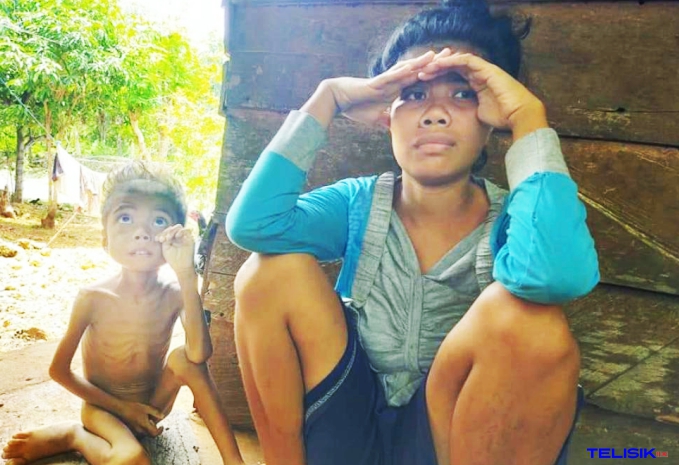 Anak di Buteng Menderita Gizi Buruk Akibat Perceraian