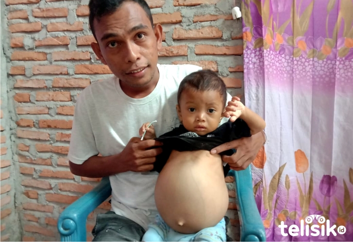 Bocah Penderita Pembengkakan Hati Butuh Uluran Tangan