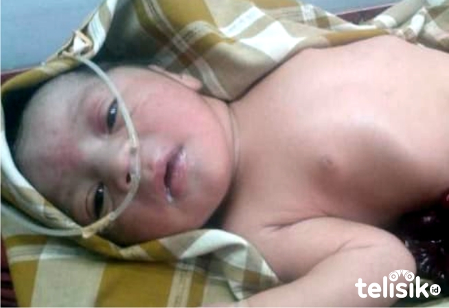 Nyawa Bayi Lahir Kondisi Usus Keluar Tidak Tertolong