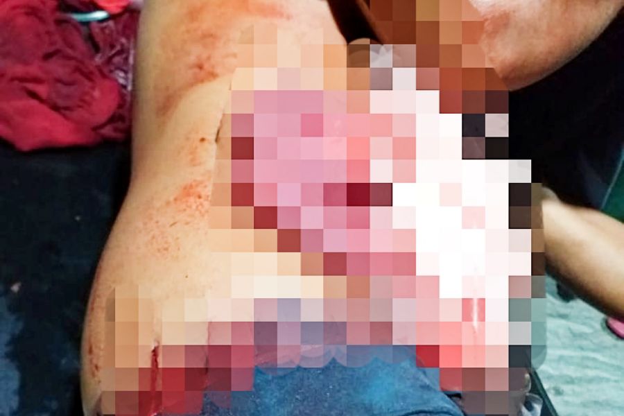 Seorang Remaja di Bombana Dijeruji Usai Parangi Rekannya Hingga Usus Keluar