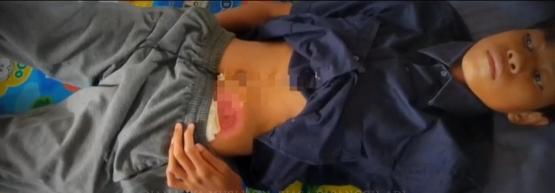 Dua Tahun Menderita Radang Usus, Tak Punya Biaya untuk Operasi