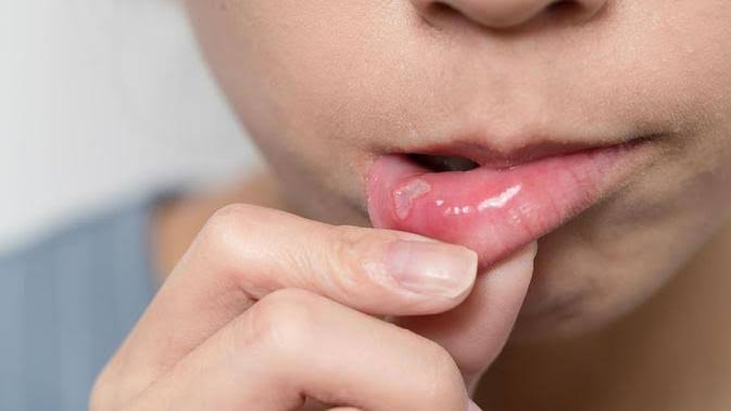 Anda Sering Sariawan? Ini 4 Obat Alami Agar Terbebas dari Rasa Perih dan Nyeri