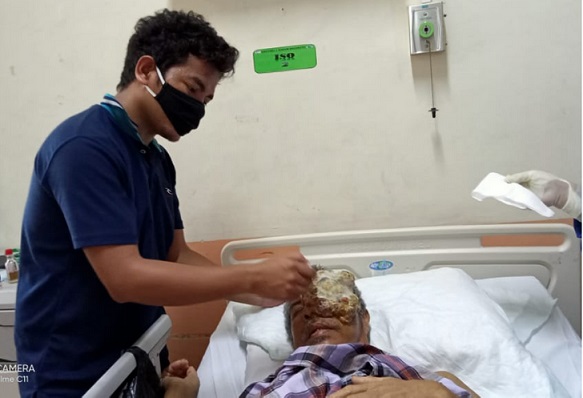 La Saidu Pengidap Tumor Mata yang Sempat Viral, Meninggal Dunia
