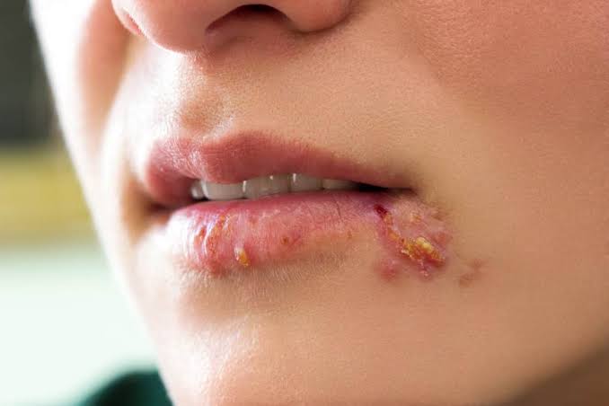 Apa itu Herpes? Kenali Gejala, Penyebab dan Cara Mengobati