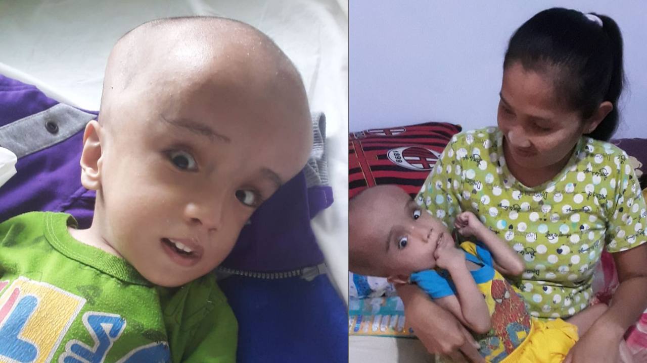 Balita Penderita Gizi Buruk dan Hidrosefalus di Buton Butuh Bantuan