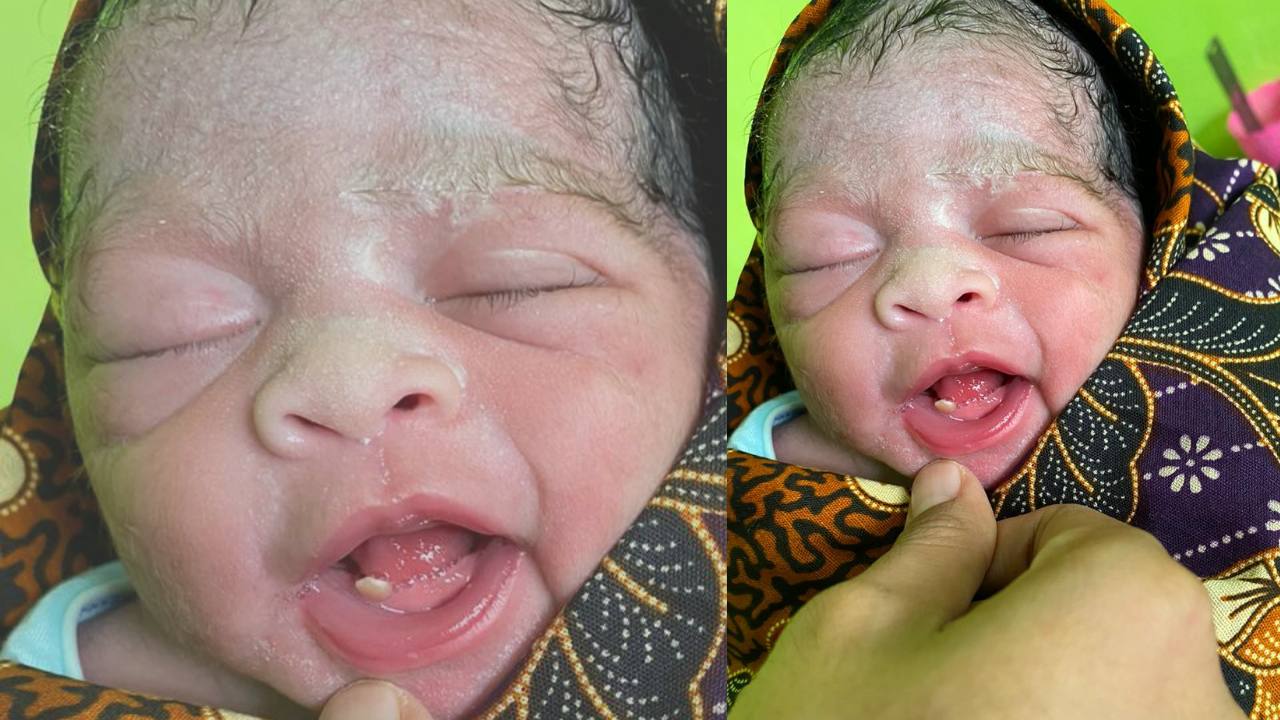 Baru Lahir, Bayi Ini Sudah Punya Satu Gigi