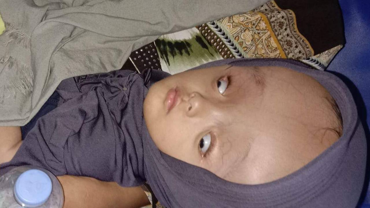 Bayi Hidrosefalus di Muna Butuh Bantuan Biaya Pengobatan