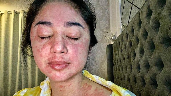 Dewi Persik Positif COVID-19 Ditandai dengan Ruam di Kulit