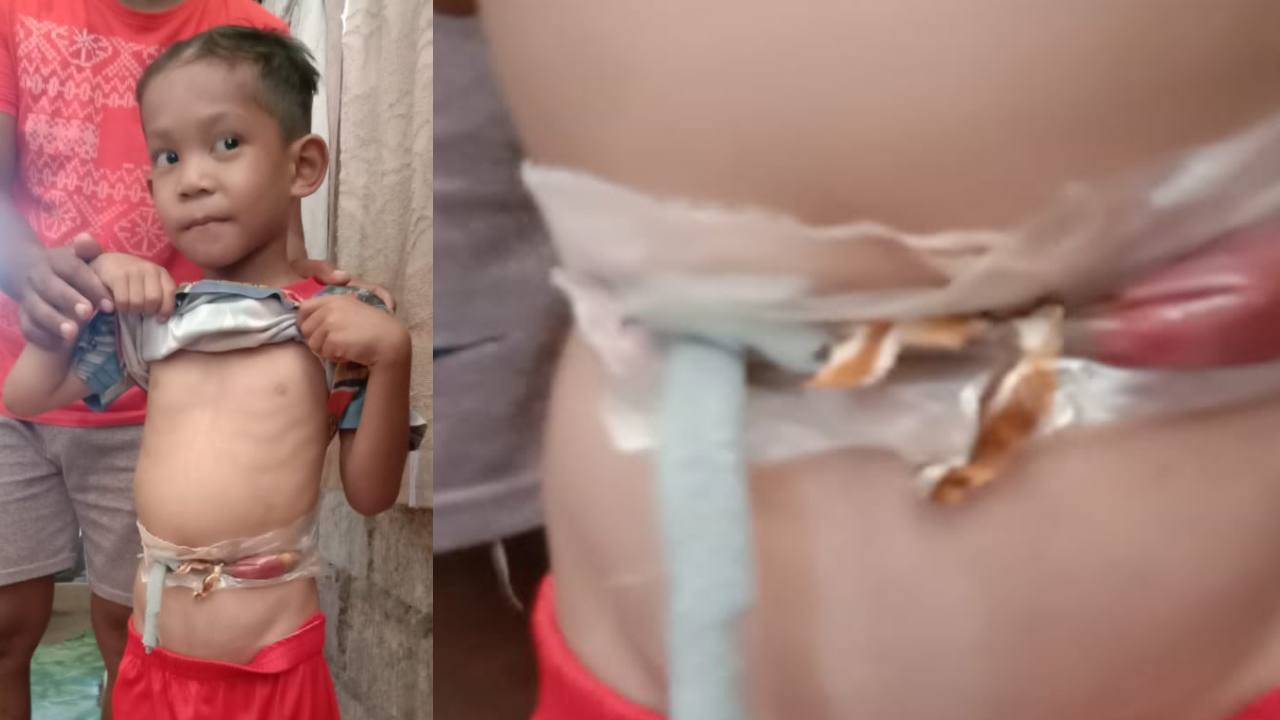 Terlahir Cacat, Anak Piatu di Buton Tengah Butuh Uluran Tangan Dermawan