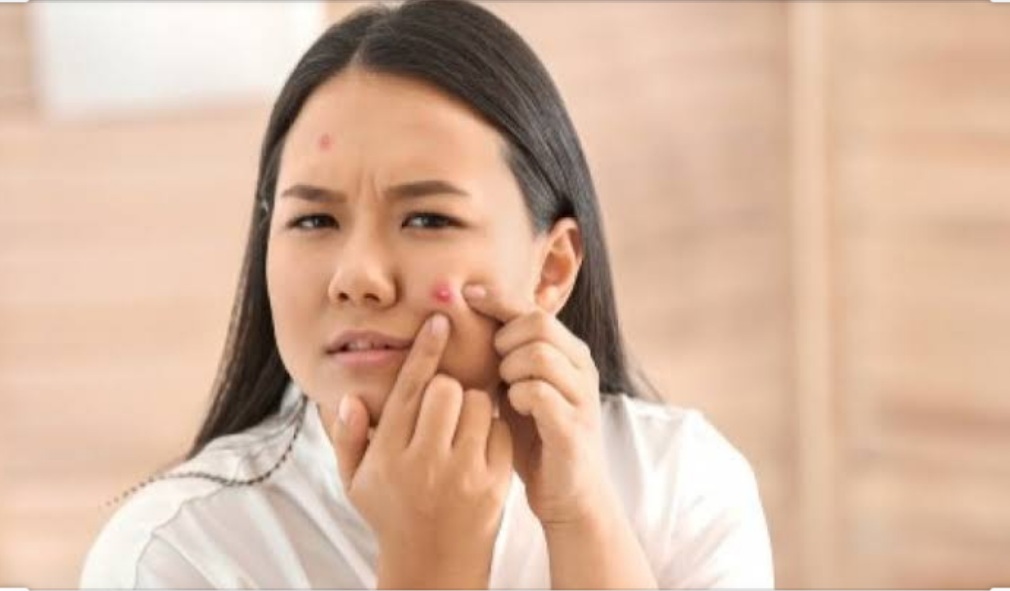 5 Kebiasaan Sepele yang Harus Dihindari Agar Jerawat Tidak Semakin Parah