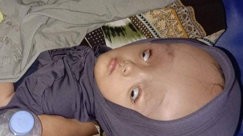 Balita Penderita Hidrosefalus Asal Muna Bakal Segera Dioperasi