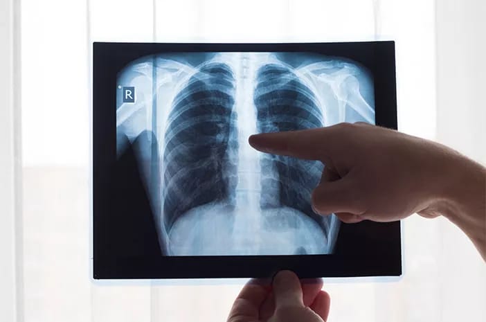 5 Penyakit Akibat Angin Malam, Rematik hingga Kematian