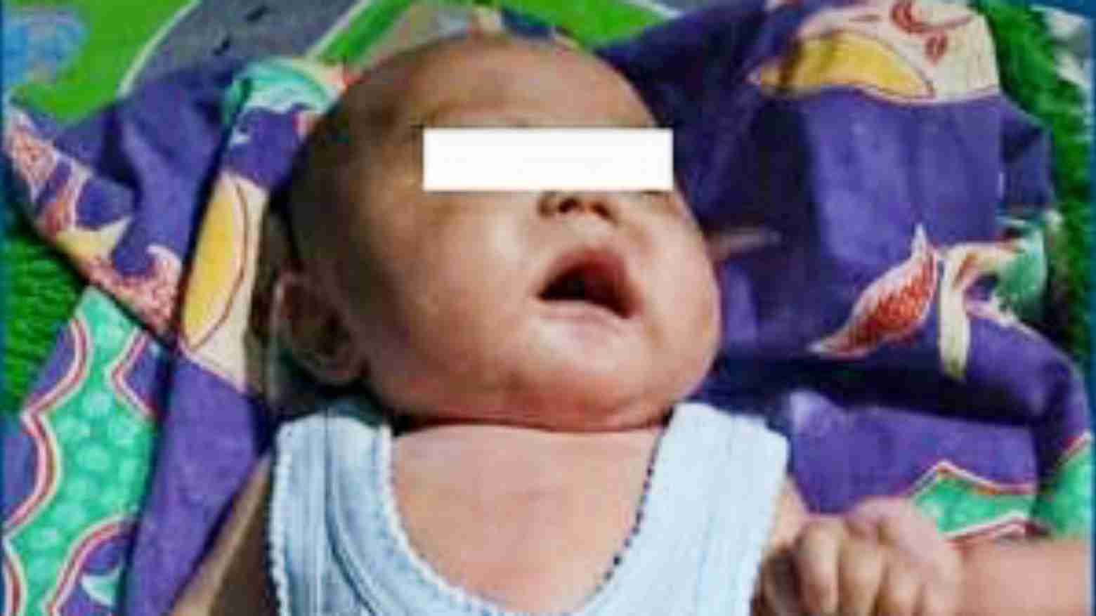 Bayi Kembar di Koltim Butuh Uluran Tangan Dermawan
