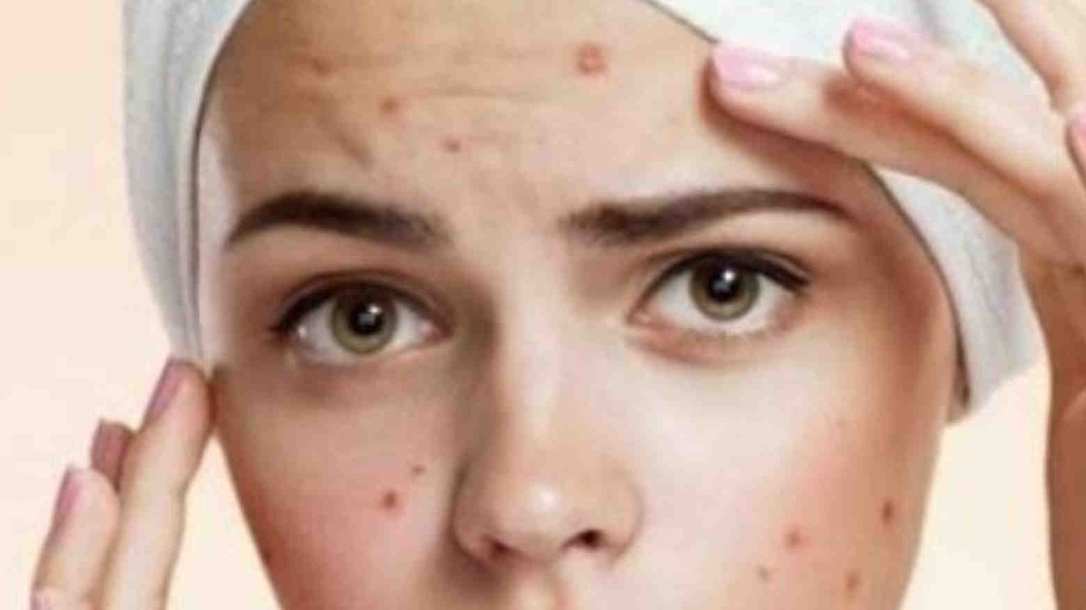 Jerawat Bermunculan saat Datang Bulan? Ini Penyebab dan Cara Mengatasinya