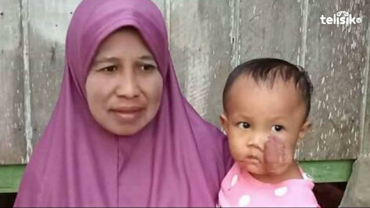 Butuh Bantuan, Balita 2 Tahun Asal Buteng Menderita Tumor Kulit