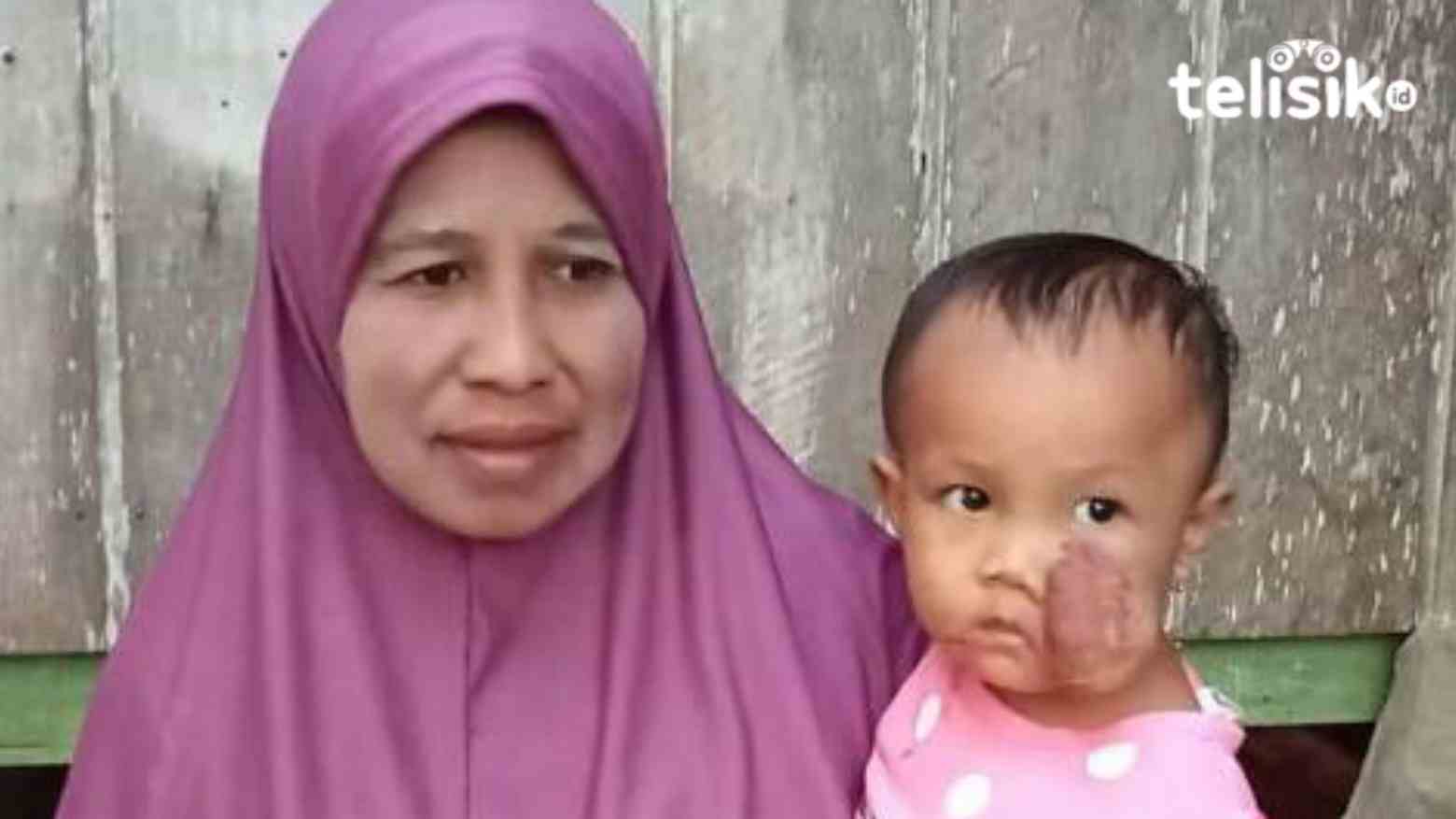 Belum Sembuh dari Kanker Kulit, Balita Asal Buteng Ini Ditinggal Ibunya