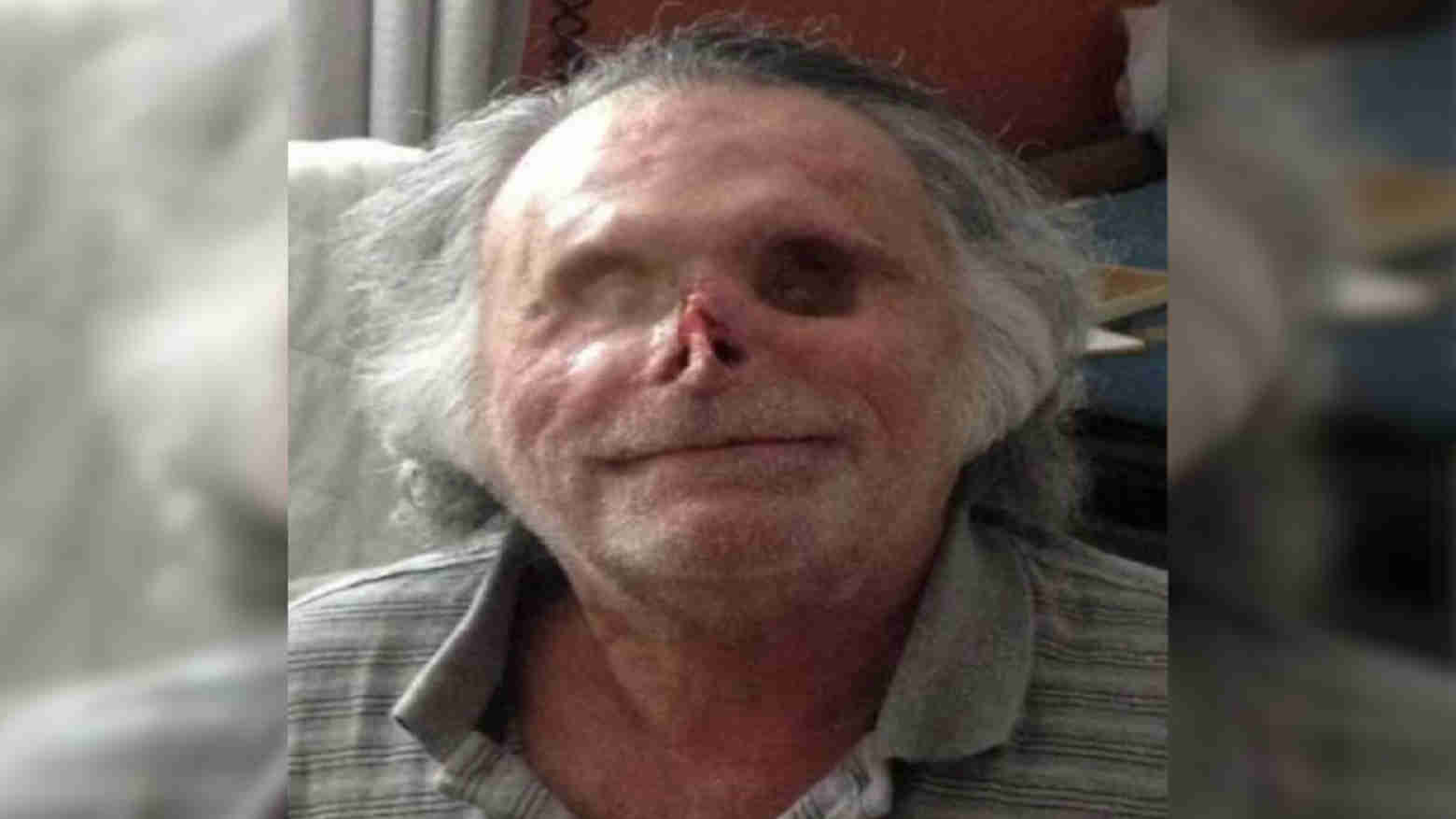 Waduh! Wajah Pria Tunawisma Ini Dimakan Zombie