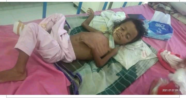 Nur Hafizah, Balita Asal Buton Penderita Gizi Buruk Butuh Uluran Tangan