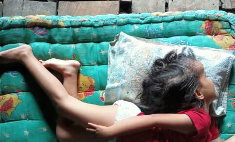 Butuh Uluran Tangan, Bocah Buteng Idap Pembengkakan Kepala dan Badan Membengkok