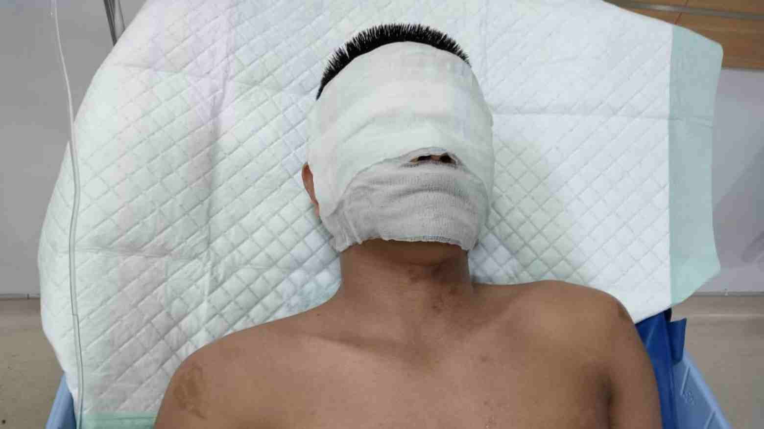 Usai Disiram Air Keras, Wartawan di Medan Malah Dilaporkan Kasus Pemerasan