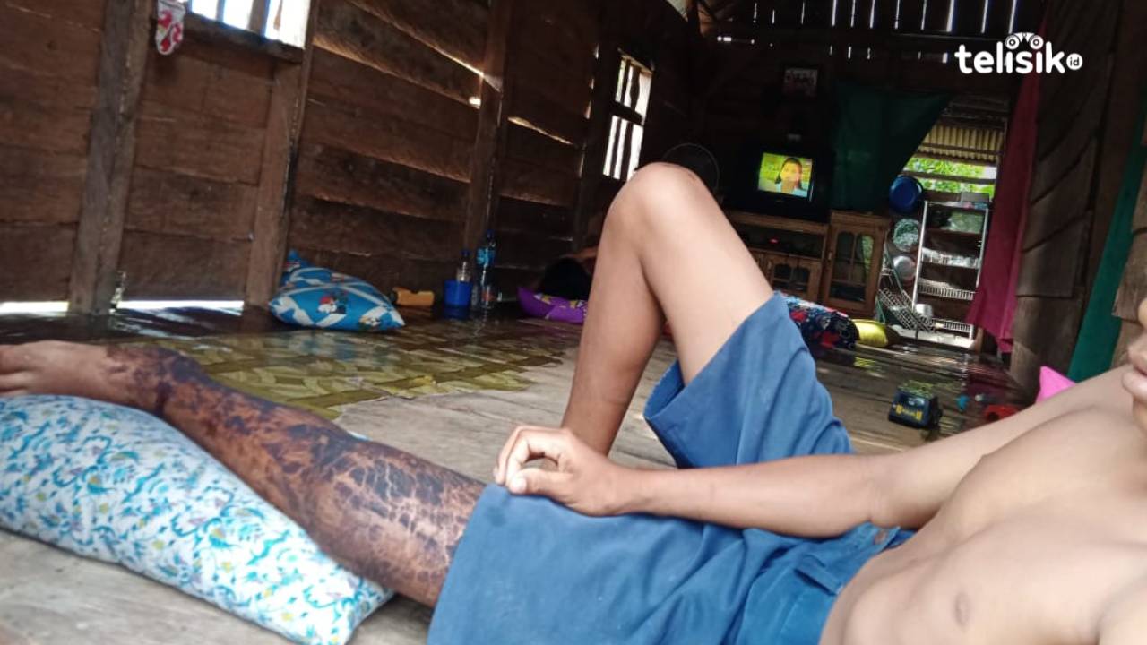 Tabrak Sapi, Pelajar SMP Alami Patah Kaki