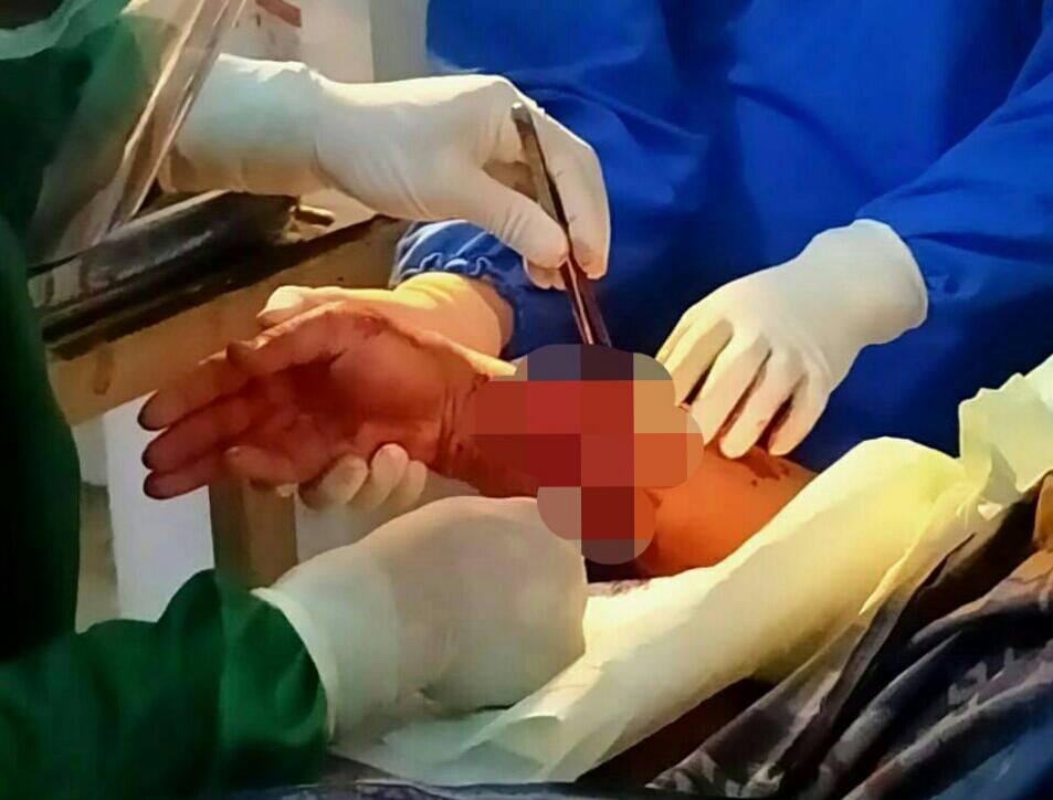 Begini Kondisi IRT di Mubar Setelah Diterkam Buaya