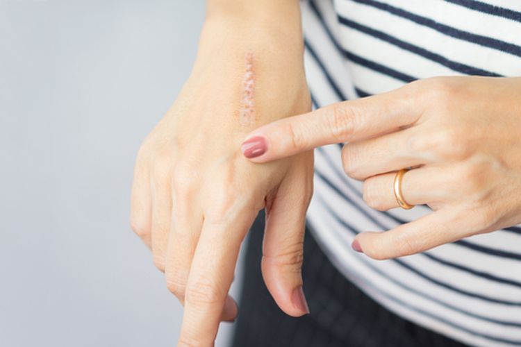 Punya Bekas Luka? Hilangkan dengan 7 Bahan Alami Ini