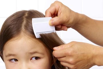 6 Obat Alami Mengatasi Kutu Rambut