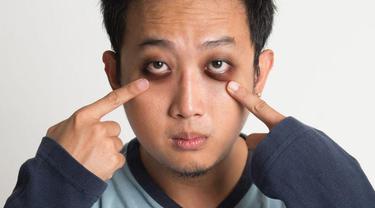 Kenali 8 Penyebab Mata Panda, dari Kurang Tidur hingga Alergi