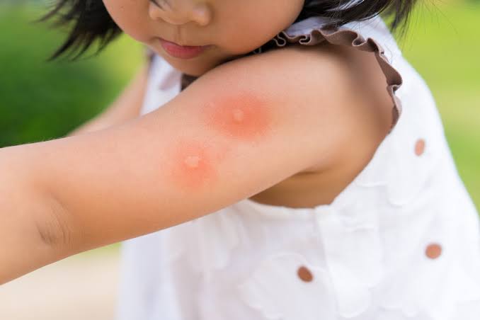 7 Cara Mudah Hilangkan Bekas Gigitan Nyamuk