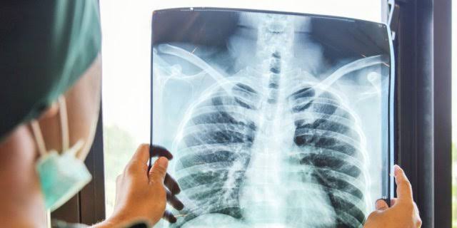 7 Tips Membersihkan Paru-Paru dari Asap Rokok