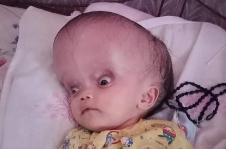 Alami Hidrosefalus, Bayi Ini Butuh Uluran Tangan