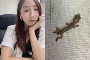 Dokter Cantik Ini Bingung Temukan Cicak Hidup Dalam Telinga Pasien, Sudah 2 Hari Tinggal