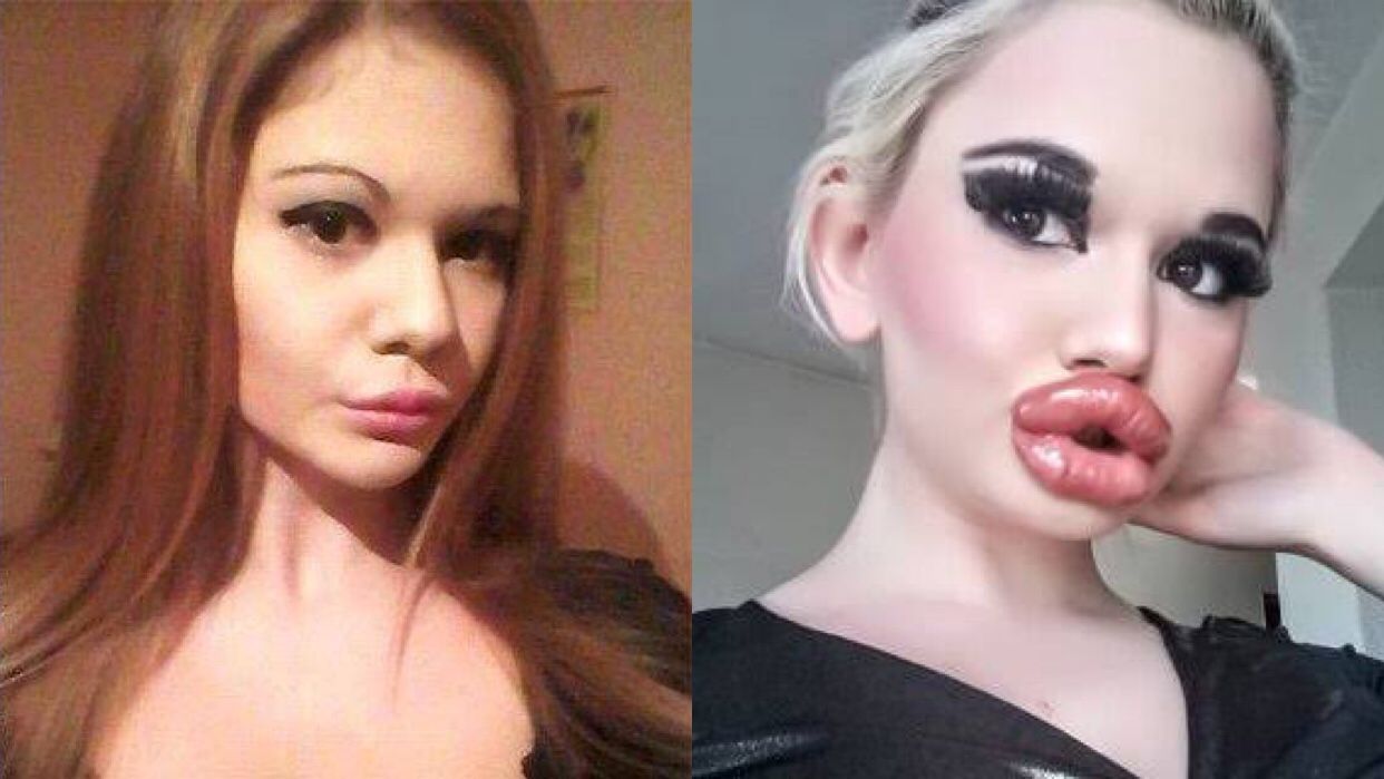 Miliki Bibir Terbesar di Dunia, Wanita Ini Tak Puas Suntik Filler Puluhan Kali