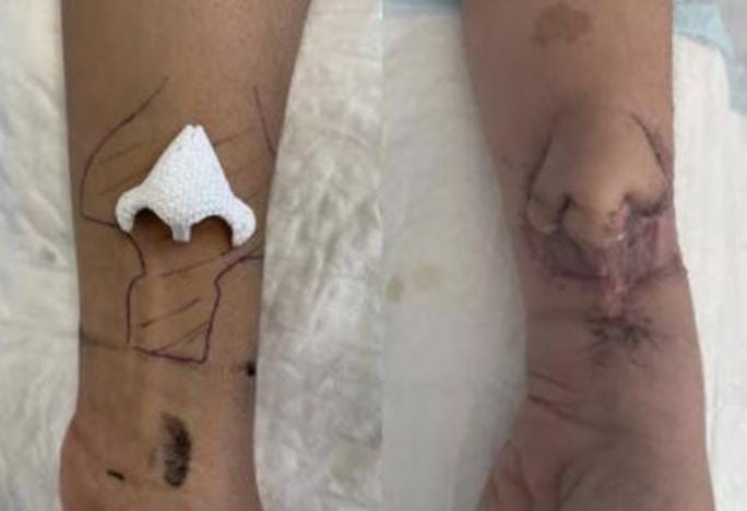 Operasi Gagal, Hidung Wanita Ini Tumbuh di Lengan