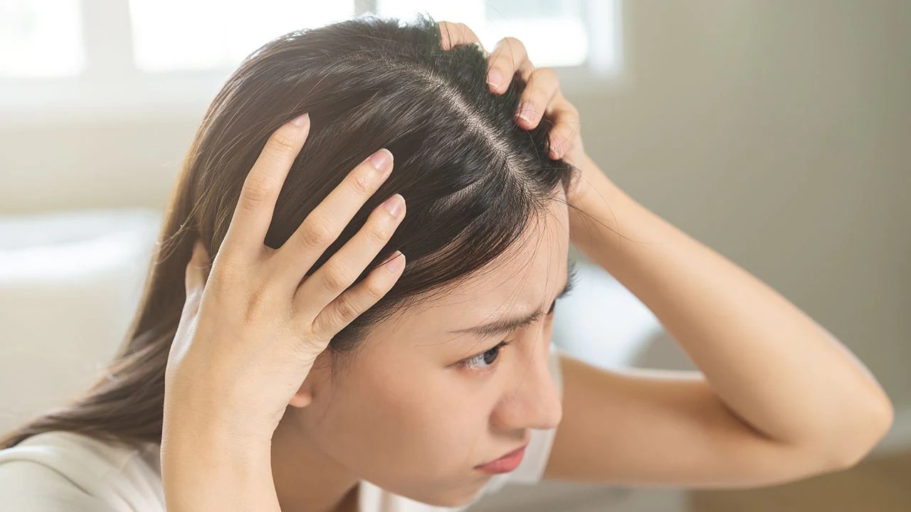 3 Bahan Alami Bisa Atasi Ketombe yang Membandel