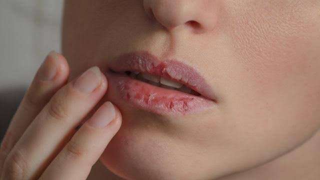 6 Tips Cegah dan Atasi Bibir Pecah-pecah