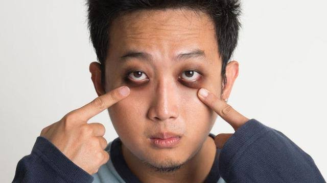 Awas, Ini 6 Kebiasaan Penyebab Mata Panda