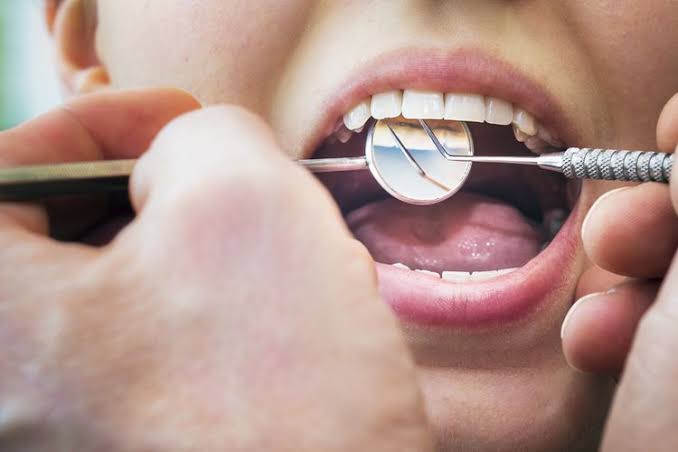 7 Cara Ampuh Mengatasi Gigi Keropos