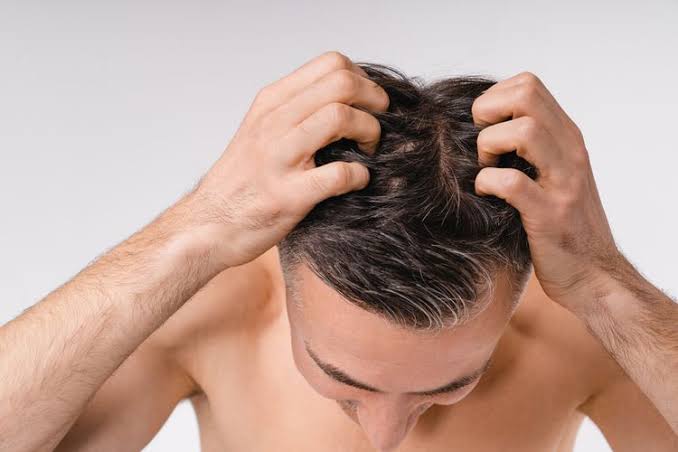 7 Tips Ampuh Hilangkan Kutu Rambut hingga Telurnya