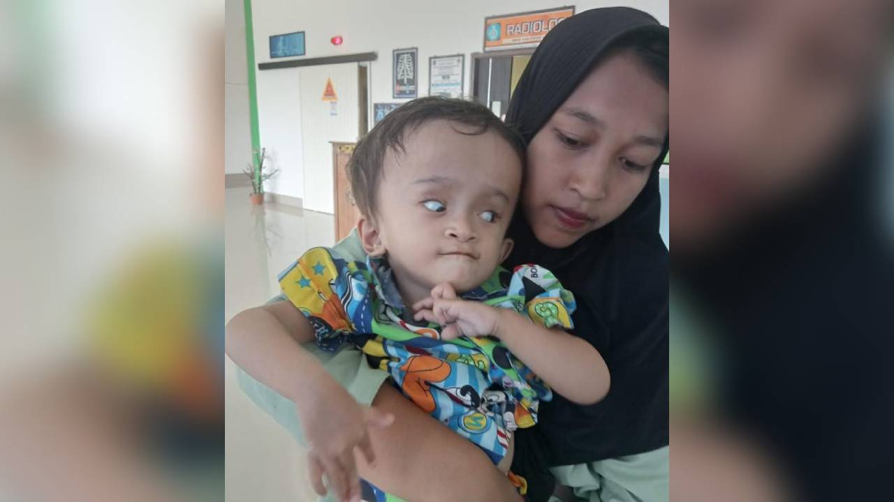Bocah Dua Tahun di Muna Barat Idap Hidrosefalus tapi Tolak Operasi
