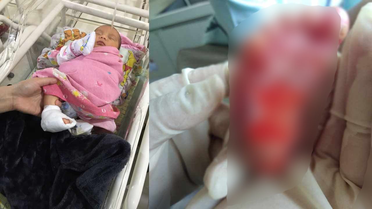 Telapak Kaki Bayi Perempuan Melepuh Diduga Usai Disuntik Perawat RS Mitra Medika