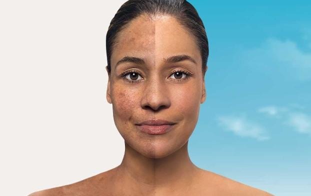 Bahan Alami Atasi Sunburn