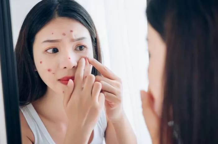 Jerawat di Wajah Ternyata Tanda Gangguan Kesehatan