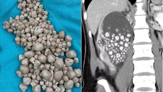 Viral, Dokter Temukan 300 Batu Ginjal pada Tubuh Wanita Ini