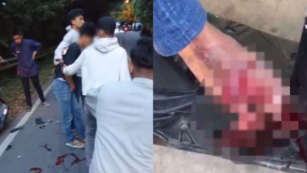 Kecelakaan di Baubau Akibatkan Telapak Kaki Korban Robek, Penabrak Tanpa Luka