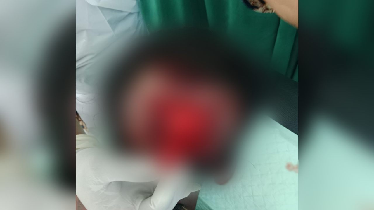 Kepala Pria di Muna Barat Bocor Usai Ditikam Saat di Permandian