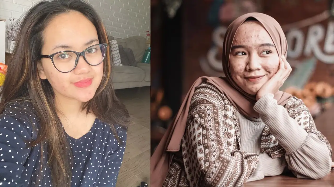 16 Obat Jerawat Paling Banyak di Apotek Diklaim Ampuh Kempeskan Jerawat