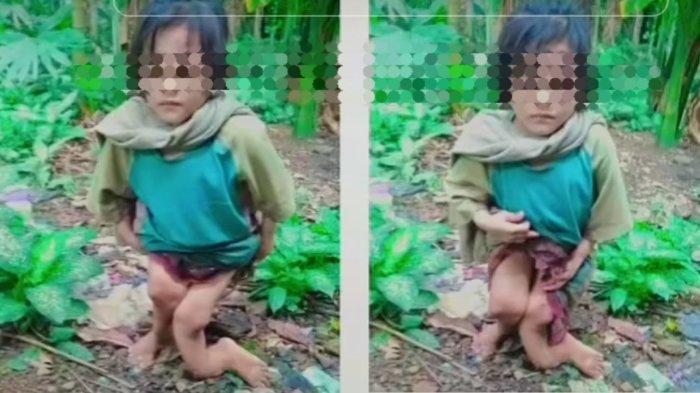 Orang Tua Bercerai, Bocah 10 Tahun Disiksa Sekeluarga hingga Tulang Kaki Bengkok