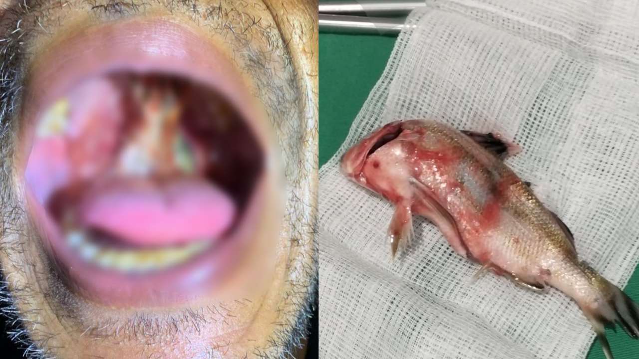 Tragis, Ikan Tangkapan Tersangkut 2 Jam di Leher Nelayan Buton